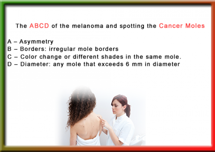 How to Spot Cancerous Moles