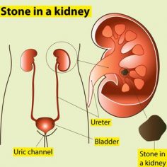 Kidney Stones Are Not to Be Ignored