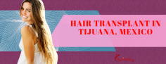 Most Affordable Hair Transplant in Tijuana, Mexico Starts at $7500