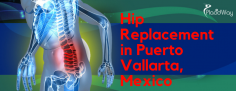 Hip Replacement in Puerto Vallarta, Mexico- Best Package