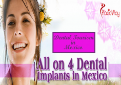 All on 4 Dental Implants Packages in Mexico