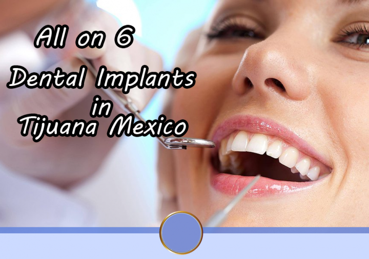 All on 6 Dental Implants Packages in Tijuana Mexico