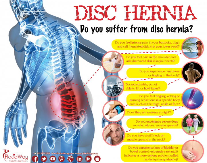 Infographics: Disc Hernia Surgery