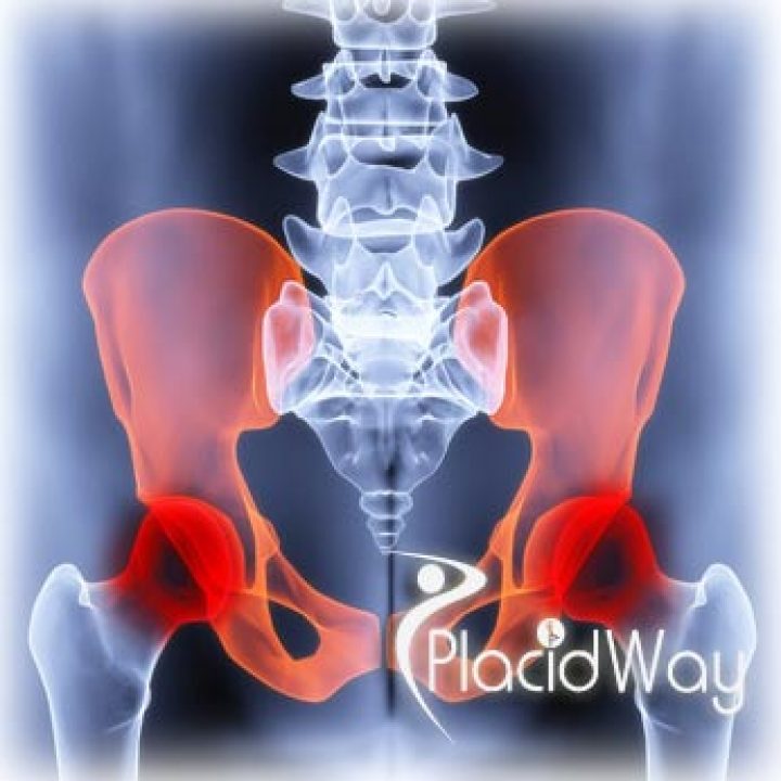 Hip Replacement Cost Affected by Medical Tourism?