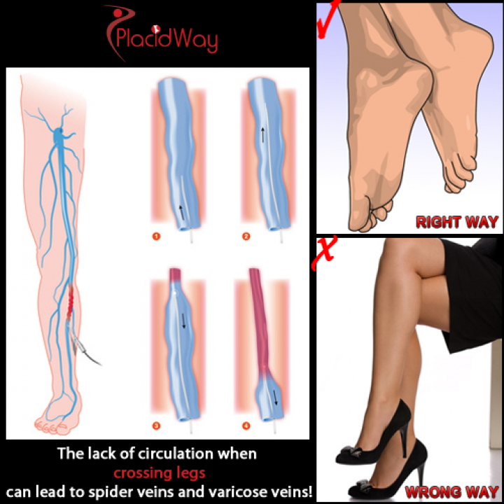 Varicose Veins Treatment and Prevention